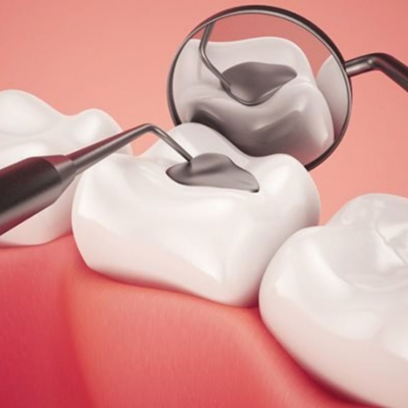 Hàn răng vĩnh viễn (độ 1 – độ 3) — ảnh 1