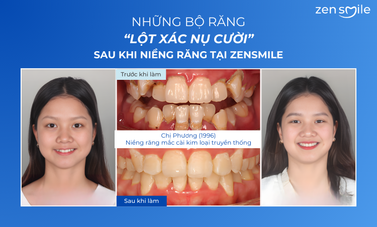 Ca trước – sau tại Nha khoa Zensmile 3
