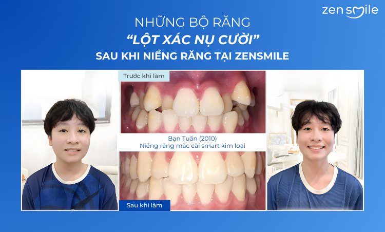 Ca trước – sau tại Nha khoa Zensmile 4