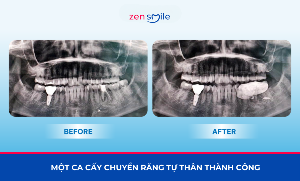 Cấy chuyển răng tự thân — ảnh 5