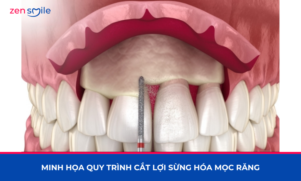 Cắt lợi sừng hoá — ảnh 4