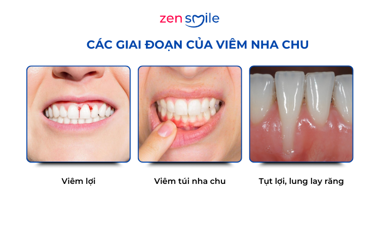 Điều trị nha chu có lật vạt — ảnh 4