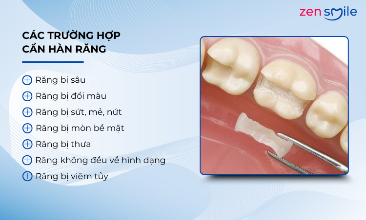 Hàn răng thẩm mỹ — ảnh 2