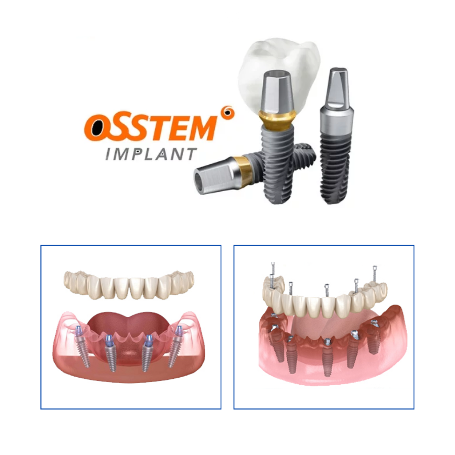 Implant All-on Osstem — ảnh 1
