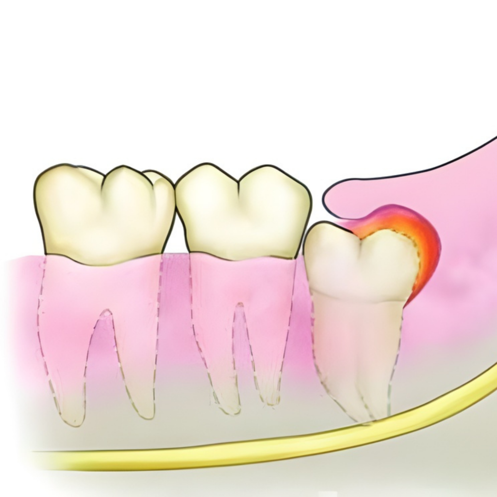 Cắt lợi sừng hoá — ảnh 1
