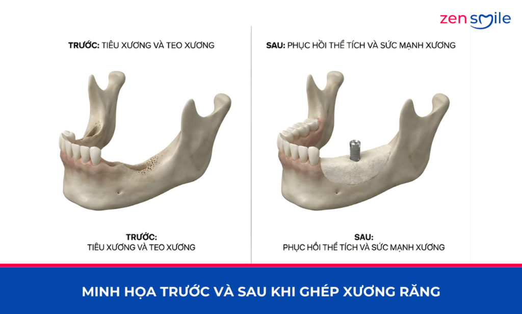 Ghép xương — ảnh 4