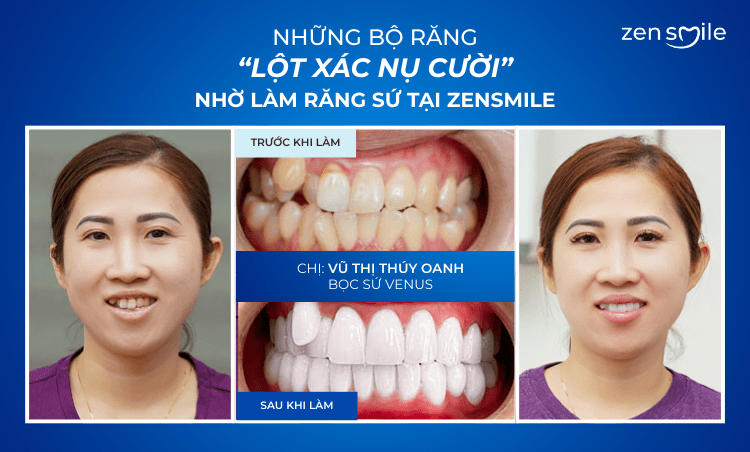 Ca trước – sau tại Nha khoa Zensmile 3