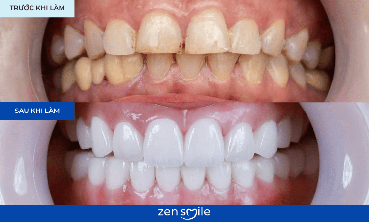 Răng sứ Cercon HT — ảnh 6