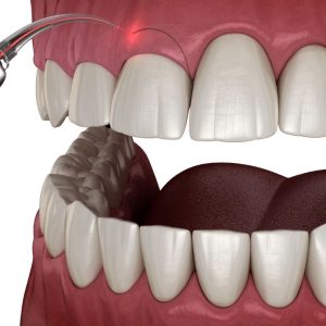 Điều trị hở lợi độ 1-3