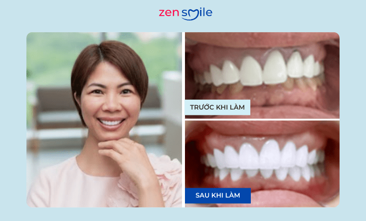 Răng sứ Cercon HT — ảnh 7