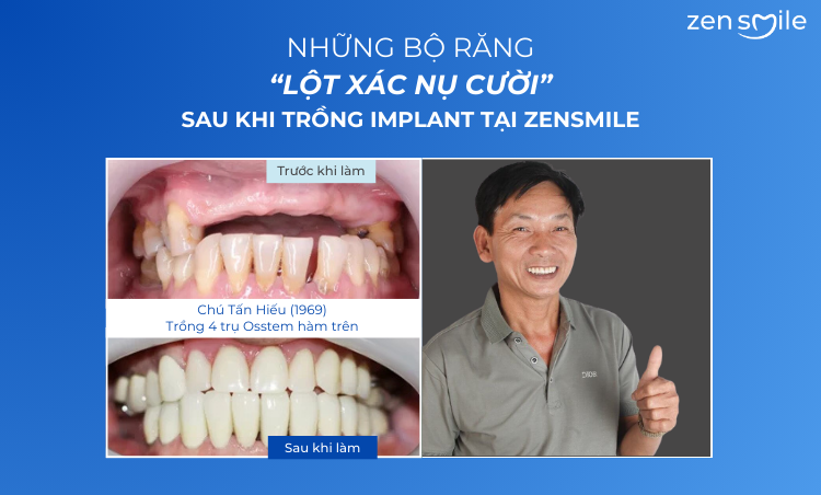Ca trước – sau tại Nha khoa Zensmile 5