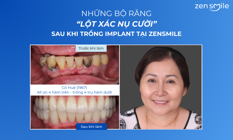 Ca trước – sau tại Nha khoa Zensmile 4