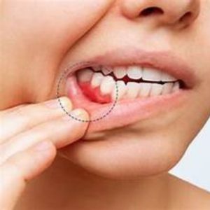 Điều trị viêm lợi mức 1-3