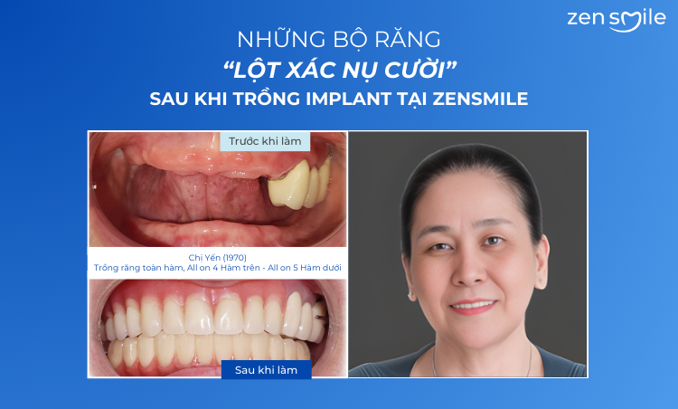 Ca trước – sau tại Nha khoa Zensmile 3