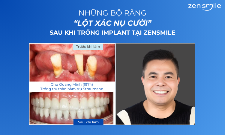 Ca trước – sau tại Nha khoa Zensmile 2