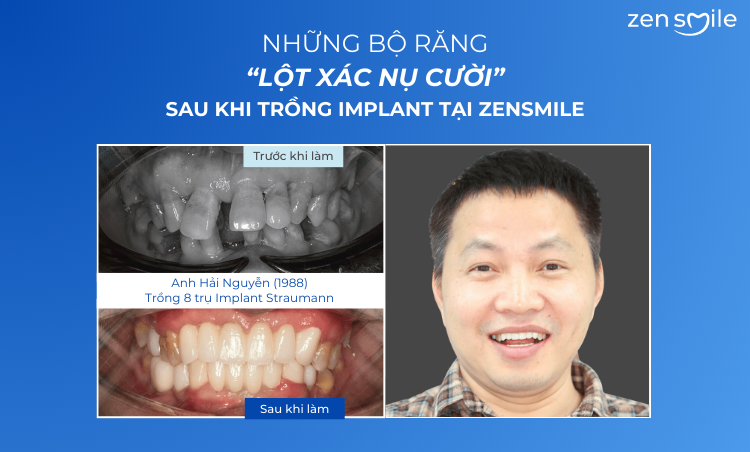 Ca trước – sau tại Nha khoa Zensmile 1