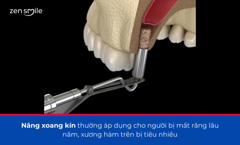 Nâng xoang — ảnh 3