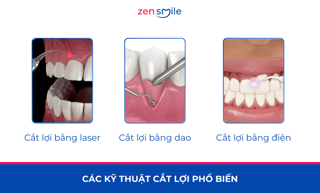 Cắt lợi sừng hoá — ảnh 3
