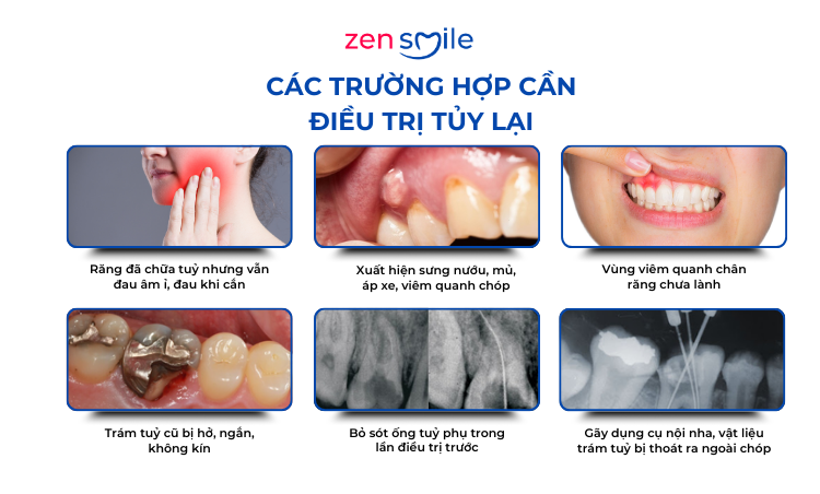 Điều trị tuỷ lại (răng đã từng điều trị tuỷ) — ảnh 3