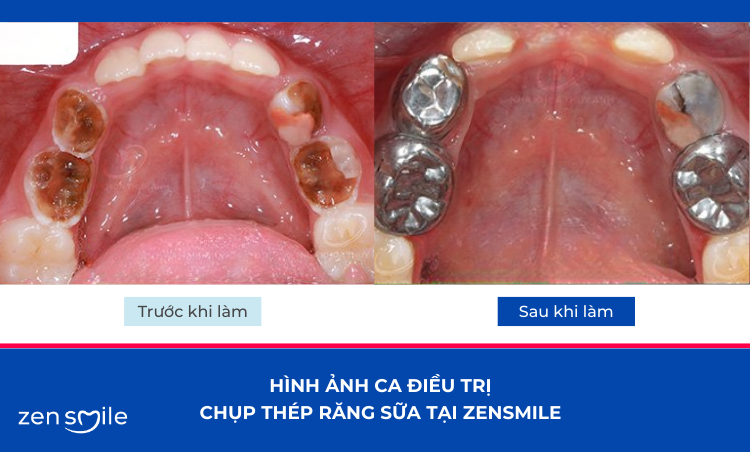 Chụp thép bảo vệ răng sữa trẻ em — ảnh 5