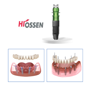 Implant All-on HIO USA