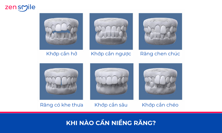 Mắc cài kim loại truyền thống — ảnh 4