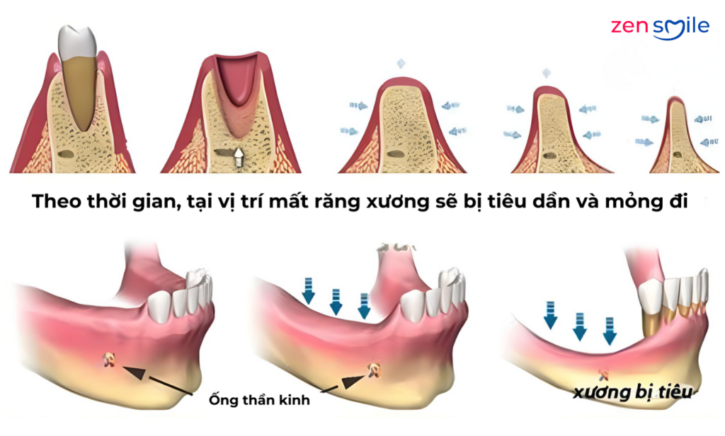 Ghép xương — ảnh 3