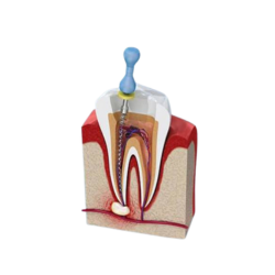 Điều trị tuỷ lại (răng đã từng điều trị tuỷ)