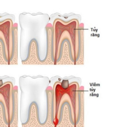 Hàn tuỷ bằng chất hàn sinh học