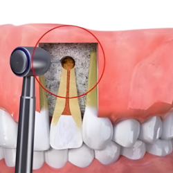 Phẫu thuật cắt chóp răng