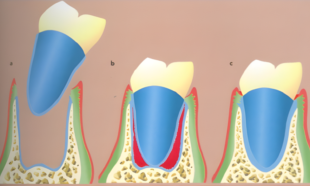 Cấy chuyển răng tự thân — ảnh 1