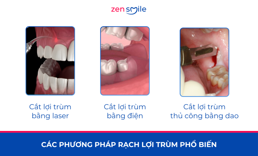 Rạch lợi trùm — ảnh 3