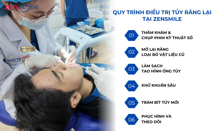 Điều trị tuỷ lại (răng đã từng điều trị tuỷ) — ảnh 4