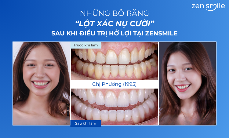 Ca trước – sau tại Nha khoa Zensmile 6