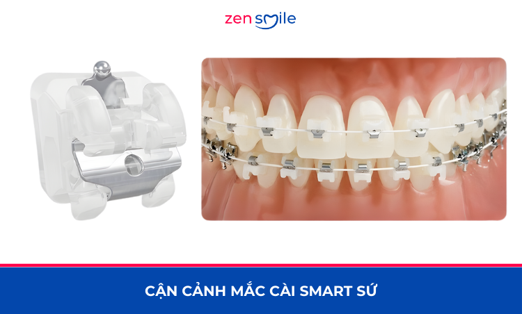 Mắc cài Smart sứ — ảnh 3