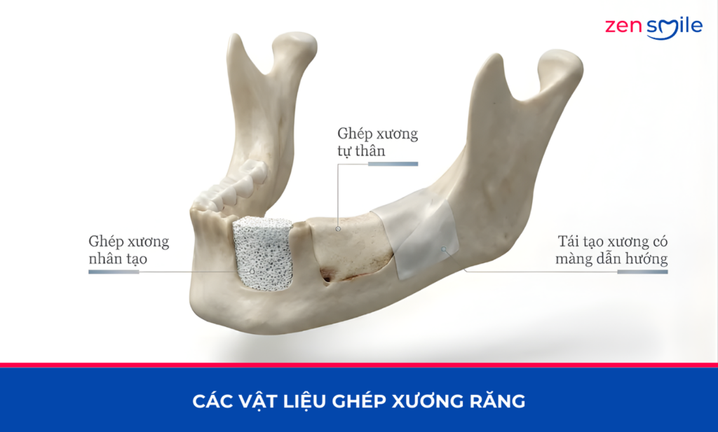 Ghép xương — ảnh 5