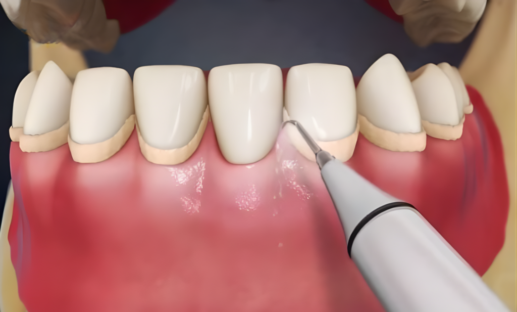 Ghép mô liên kết — ảnh 3