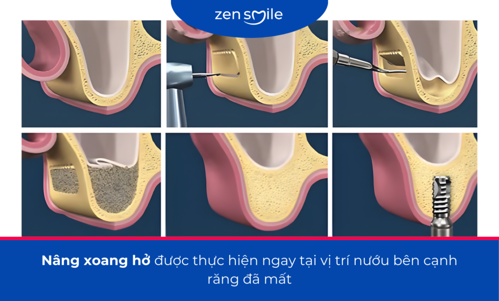 Nâng xoang — ảnh 4