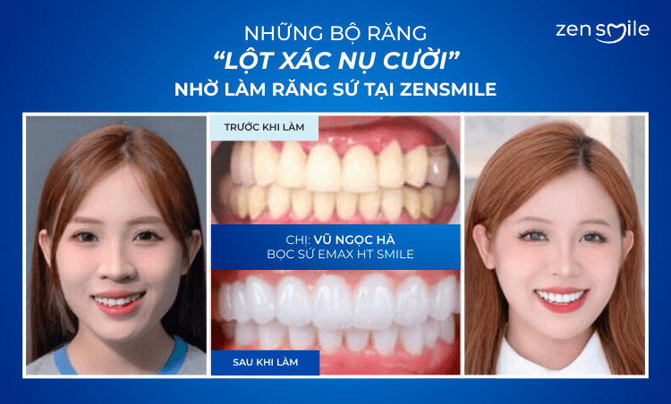 Ca trước – sau tại Nha khoa Zensmile 1