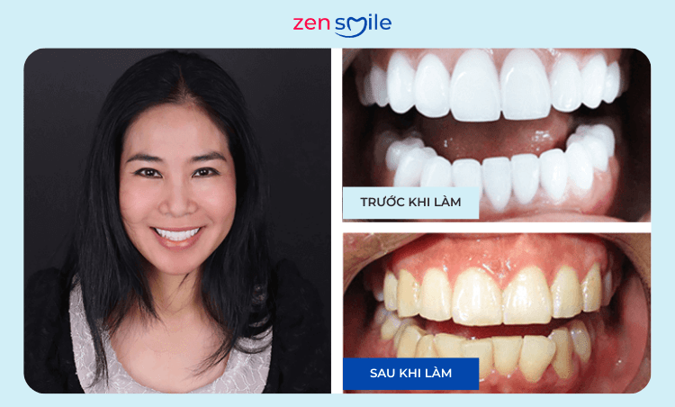 Răng sứ Lava Plus — ảnh 6