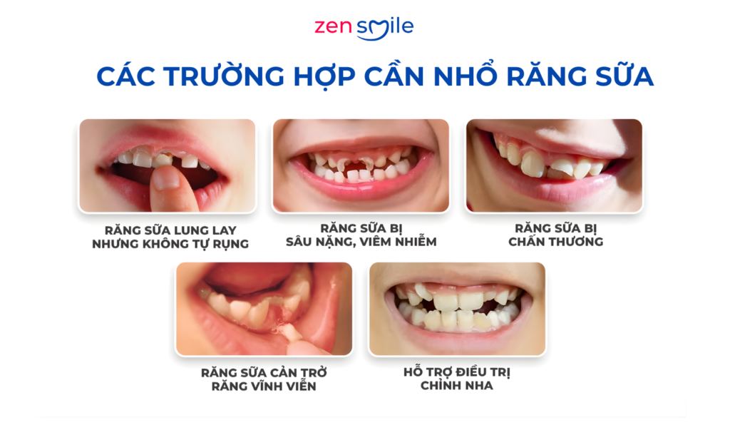 Nhổ răng em bé — ảnh 3