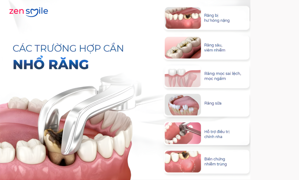 Nhổ răng người lớn — ảnh 6