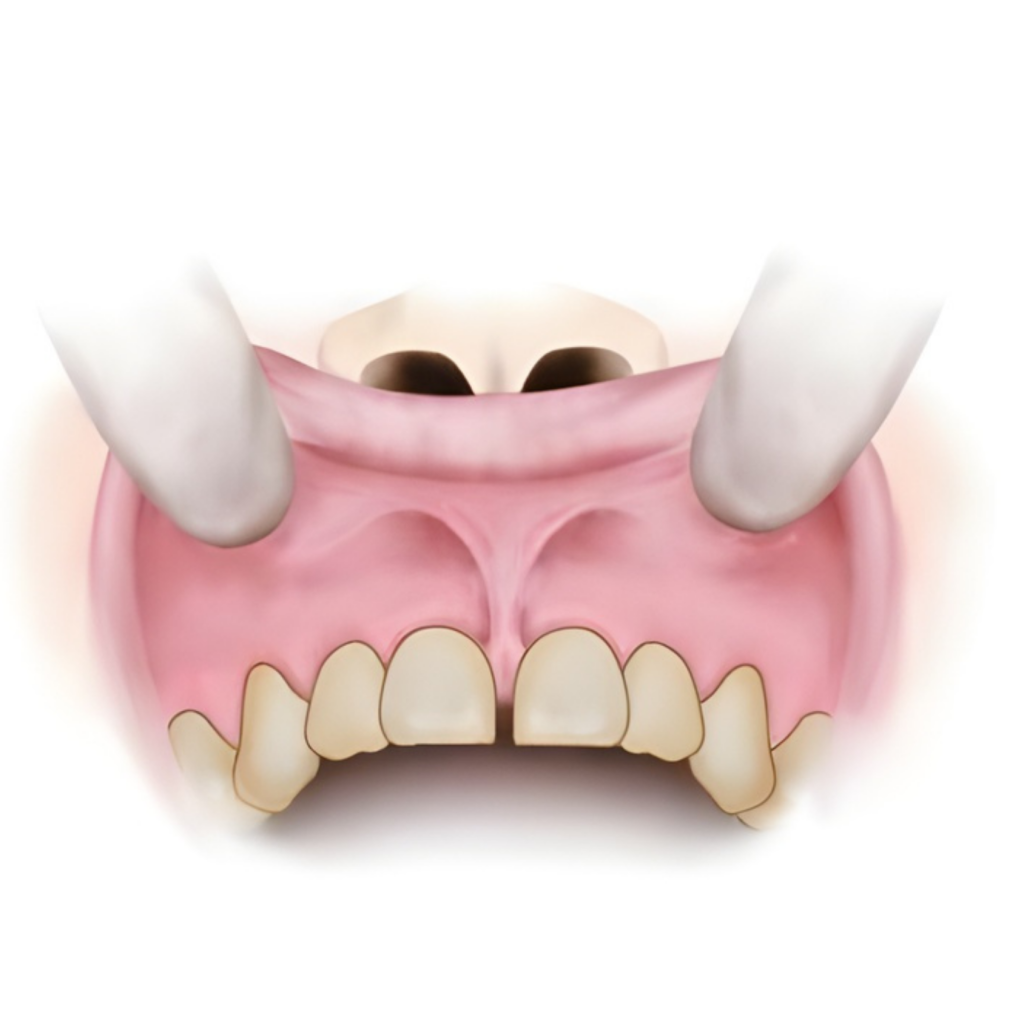 Cắt phanh môi, lưỡi — ảnh 1