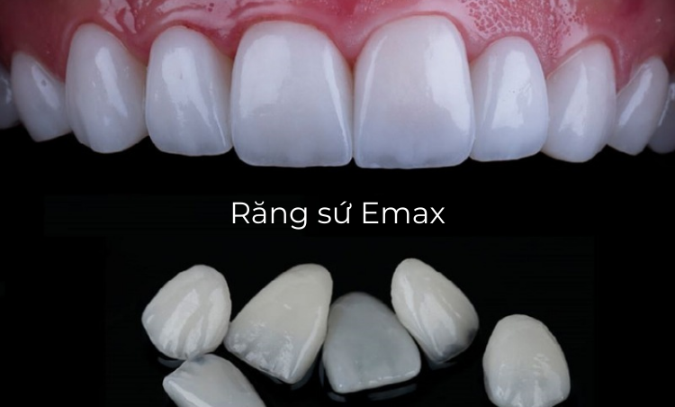 Răng sứ Emax — ảnh 4