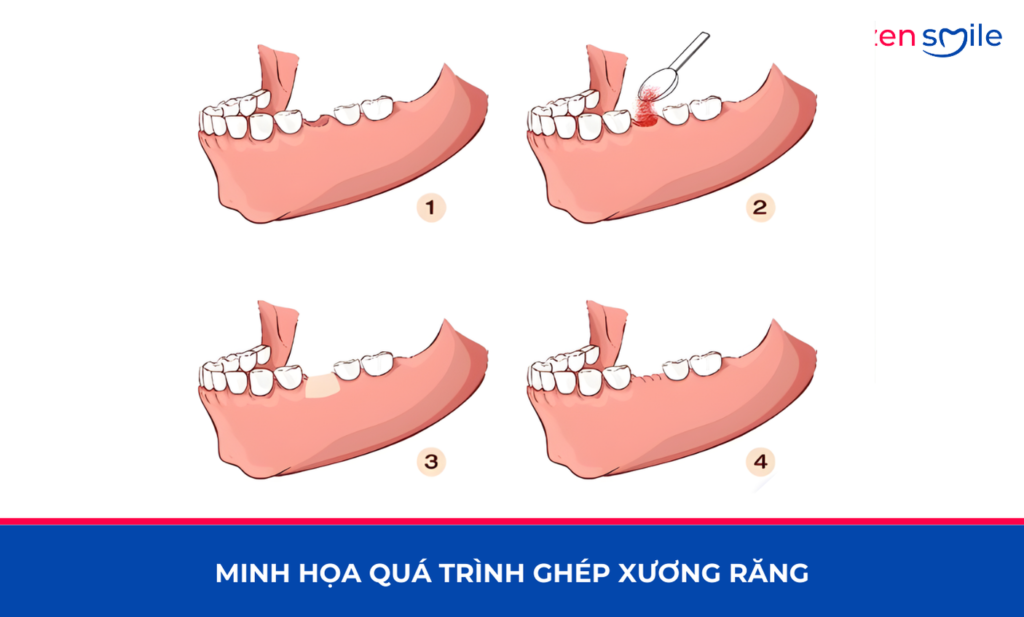 Ghép xương — ảnh 6