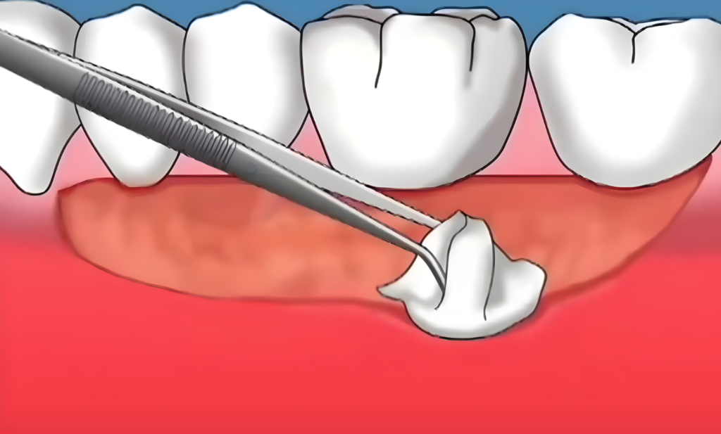Ghép mô liên kết — ảnh 4