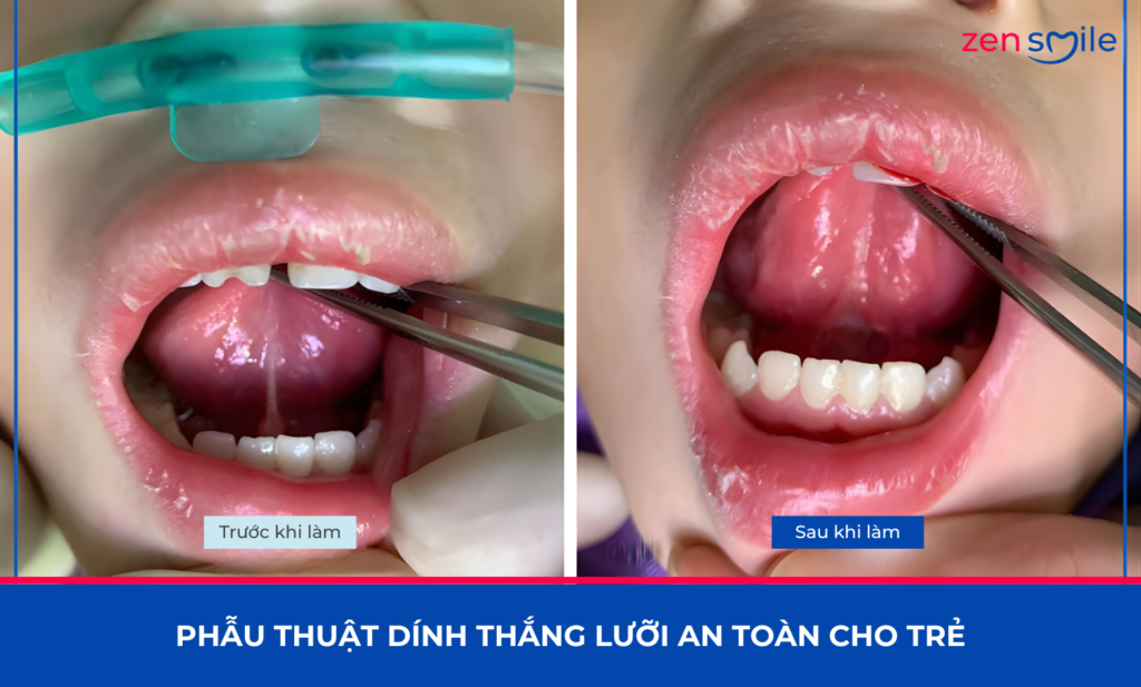 Cắt phanh môi, lưỡi — ảnh 3