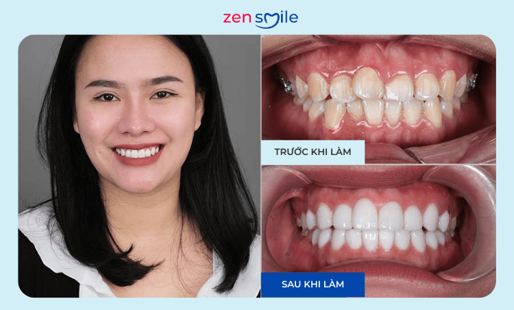 Răng sứ Lava Plus — ảnh 7