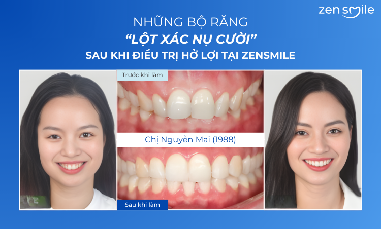 Ca trước – sau tại Nha khoa Zensmile 4