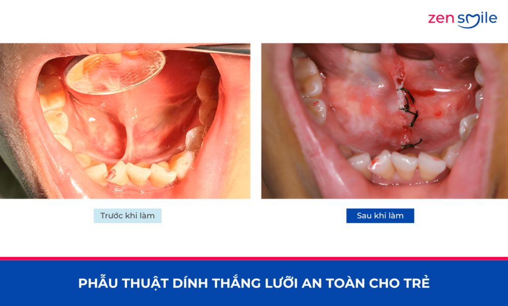 Cắt phanh môi, lưỡi — ảnh 4